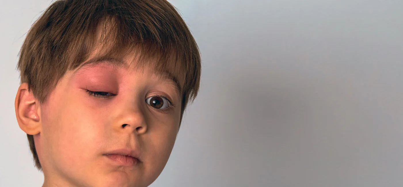 Herediter Anjioödem