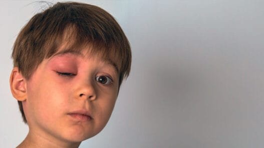 Herediter Anjioödem Nedir? Belirtiler ve Tedavi Yöntemleri