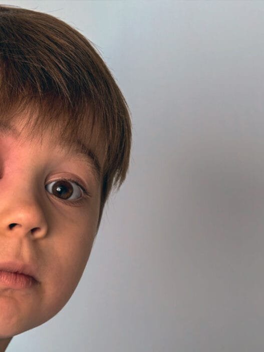 Herediter Anjioödem