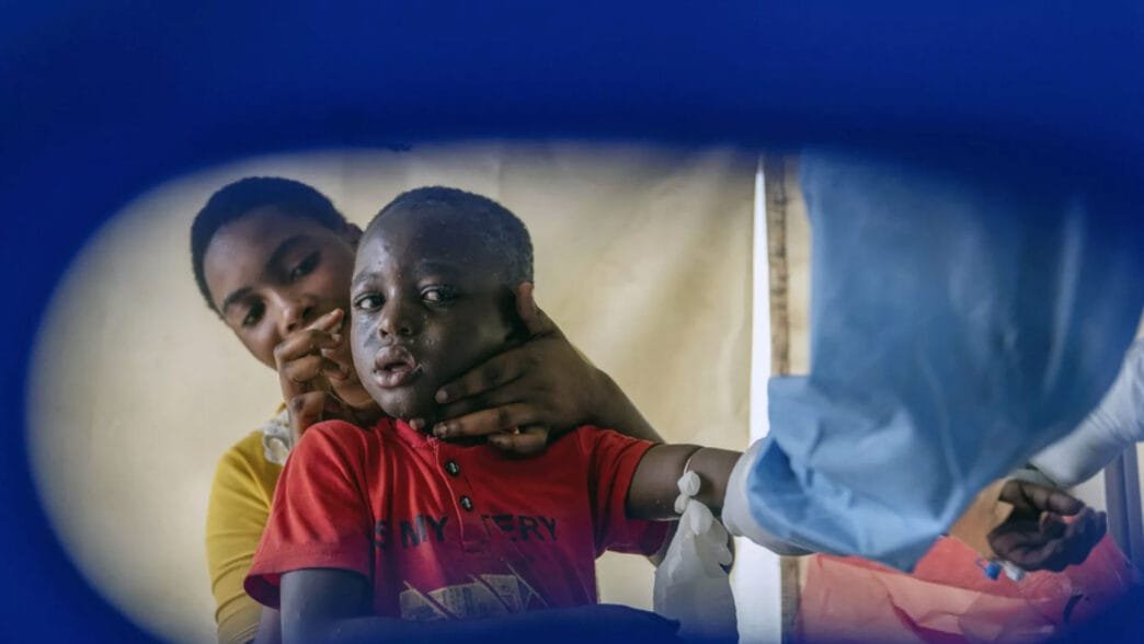 Maymun Çiçeği Aşısı