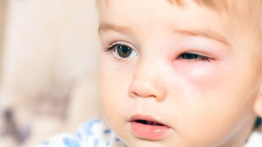 Her Şişlik ve Kızarıklık Alerji Olmayabilir: Herediter Anjioödem Tehlikesine Dikkat