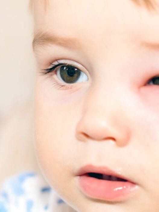 Her Şişlik ve Kızarıklık Alerji Olmayabilir: Herediter Anjioödem Tehlikesine Dikkat