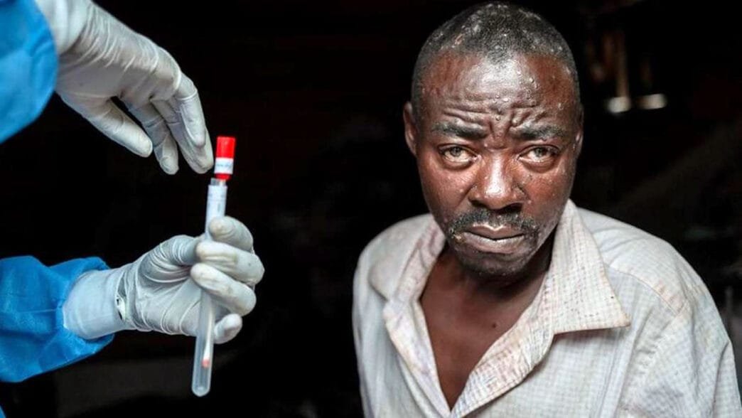 Kongo Demokratik Cumhuriyeti Mpox Salgını