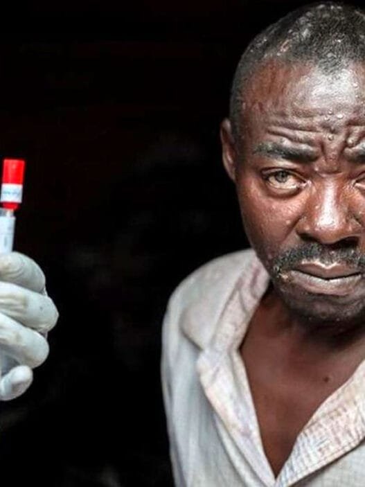 Kongo Demokratik Cumhuriyeti Mpox Salgını