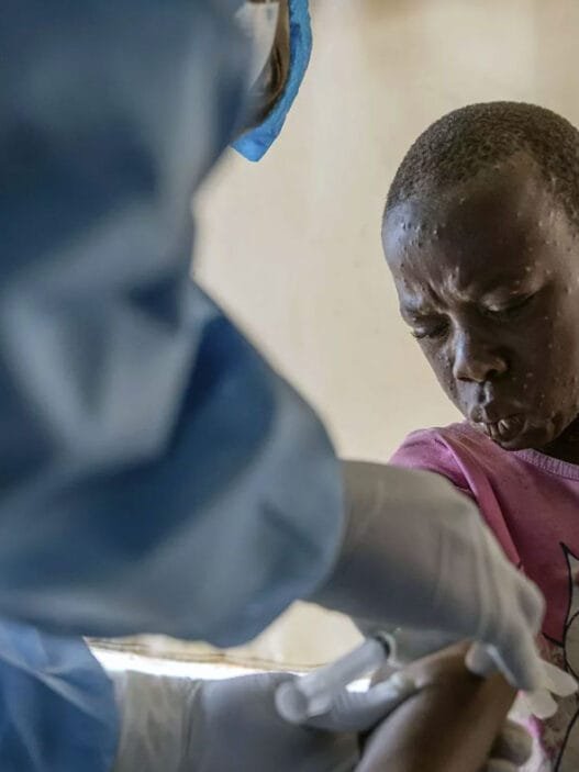 Afrika Maymun çiçeği Virüsü