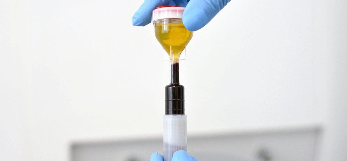 PRP ile Yumurtalık Gençleştirme Nedir?