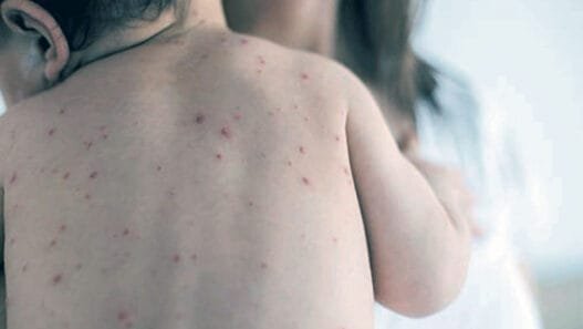 Çocuklarda Alerji ve Enfeksiyon İlişkisi: Uzmandan Önemli Uyarılar!