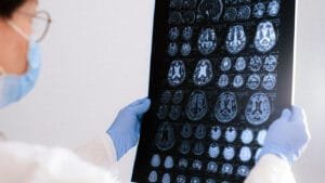 Alzheimer Araştırması